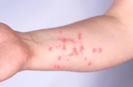 Caso suspeito de Mpox é descartado após exame negativo no Acre