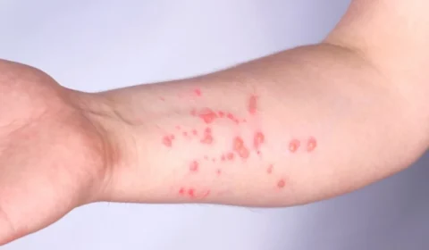 Caso suspeito de Mpox é descartado após exame negativo no Acre