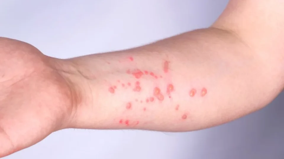 Caso suspeito de Mpox é descartado após exame negativo no Acre