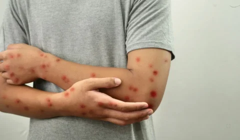 Mpox: Brasil registra mais de 50 casos da doença em 2026, informa Ministério da Saúde