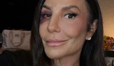 Ivete Sangalo volta aos palcos após acidente doméstico e aparece com hematoma no rosto