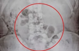 Mãe é flagrada com drogas no estômago ao transportar substâncias para o filho em Porto Velho