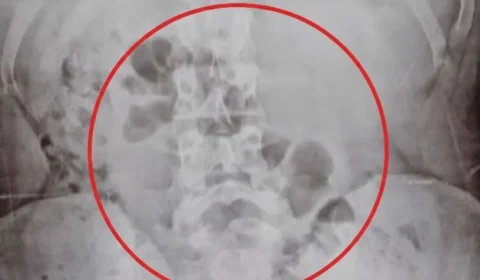 Mãe é flagrada com drogas no estômago ao transportar substâncias para o filho em Porto Velho