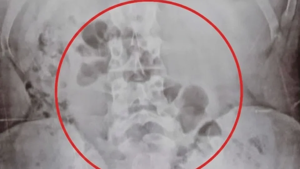 Mãe é flagrada com drogas no estômago ao transportar substâncias para o filho em Porto Velho