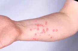 Rondônia registra 11 casos confirmados de Mpox em 2026