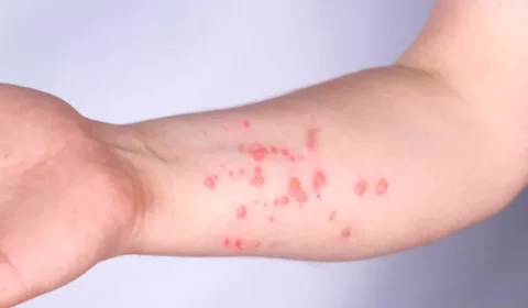 Rondônia registra 11 casos confirmados de Mpox em 2026