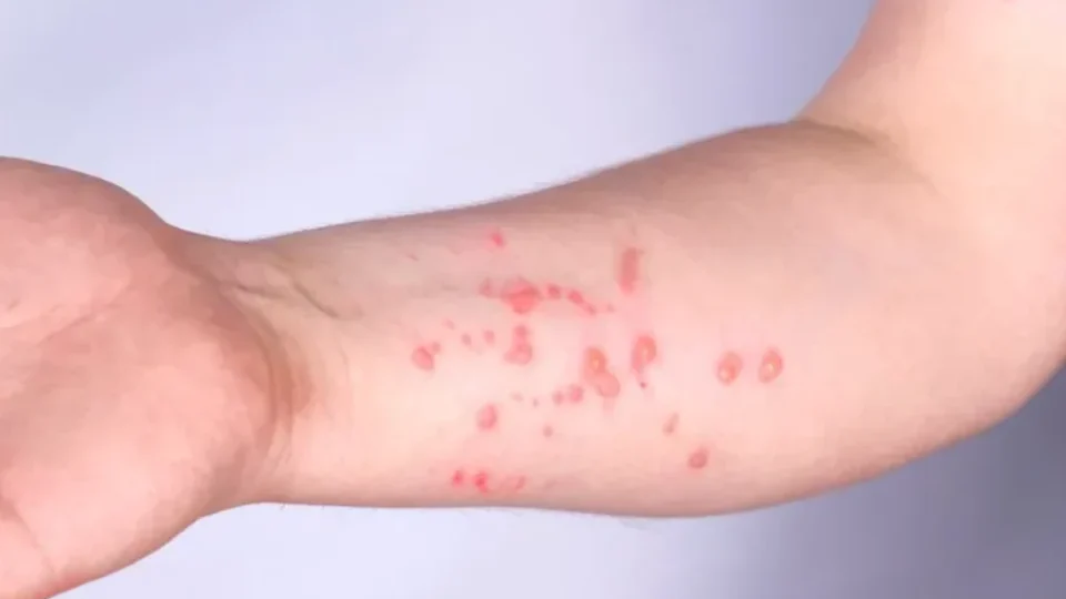 Rondônia registra 11 casos confirmados de Mpox em 2026