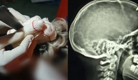 Briga entre irmãos deixa adolescente com faca cravada na cabeça