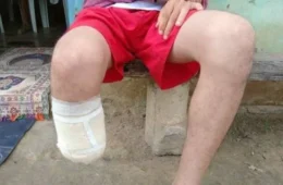 Homem amputa o próprio pé para receber seguro de R$ 1,5 milhão e é condenado na Bahia