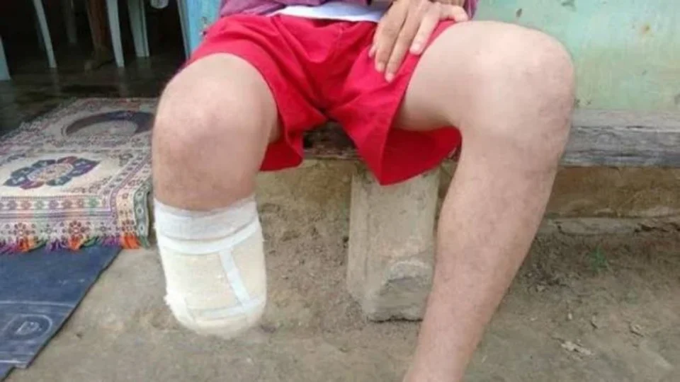 Homem amputa o próprio pé para receber seguro de R$ 1,5 milhão e é condenado na Bahia