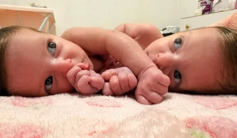 Gêmeas siamesas vão passar por cirurgia pelo SUS e família faz campanha para custear estadia em Goiânia