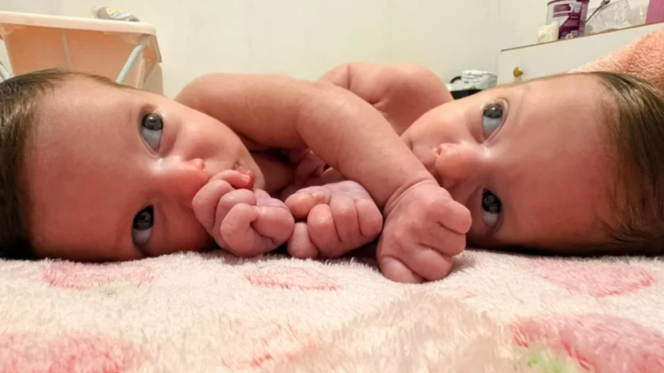 Gêmeas siamesas vão passar por cirurgia pelo SUS e família faz campanha para custear estadia em Goiânia
