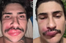 Influenciador é internado após espremer espinha e faz alerta sobre risco de complicações graves