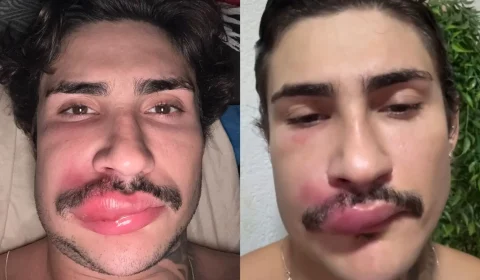 Influenciador é internado após espremer espinha e faz alerta sobre risco de complicações graves