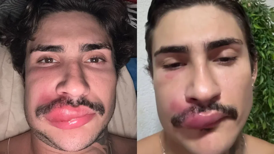 Influenciador é internado após espremer espinha e faz alerta sobre risco de complicações graves