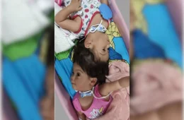 Gêmeas siamesas morrem após cirurgia de separação em São Paulo