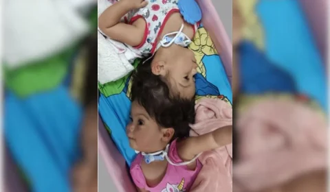 Gêmeas siamesas morrem após cirurgia de separação em São Paulo