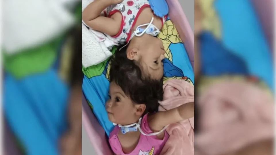 Gêmeas siamesas morrem após cirurgia de separação em São Paulo