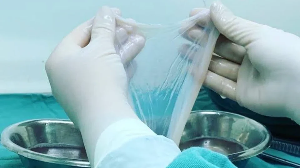 Cientistas usam membrana da placenta para tratar ferida difícil e evitar cirurgia