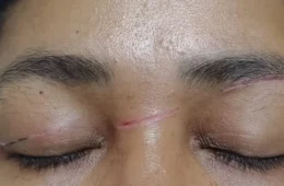 Diarista sofre cortes no rosto e no pescoço por linha de cerol enquanto andava de moto no Acre: “Nasci de novo”