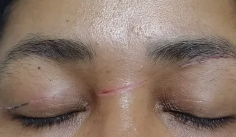 Diarista sofre cortes no rosto e no pescoço por linha de cerol enquanto andava de moto no Acre: “Nasci de novo”