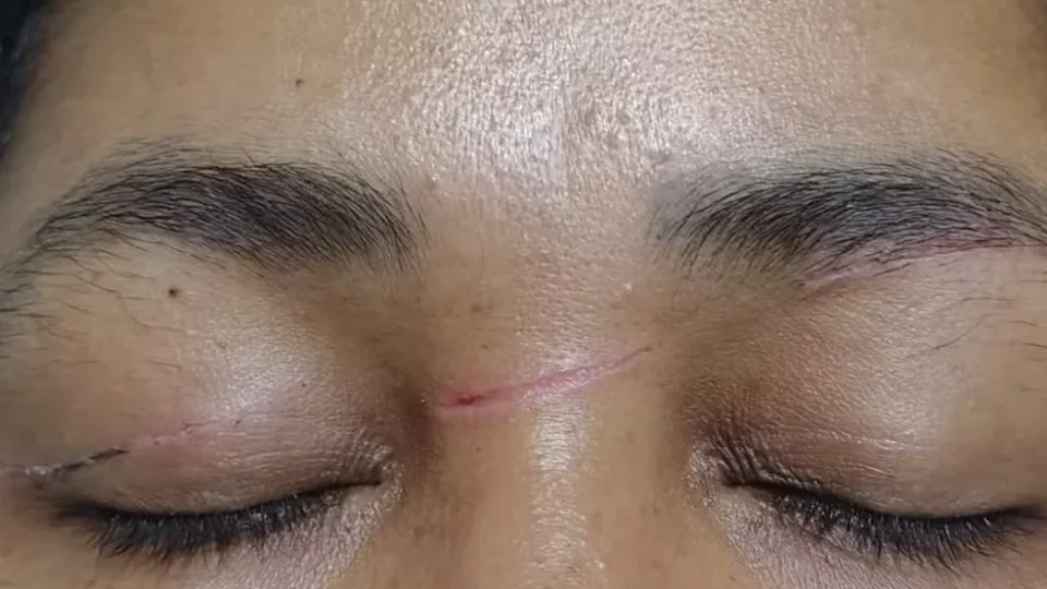 Diarista sofre cortes no rosto e no pescoço por linha de cerol enquanto andava de moto no Acre: “Nasci de novo”