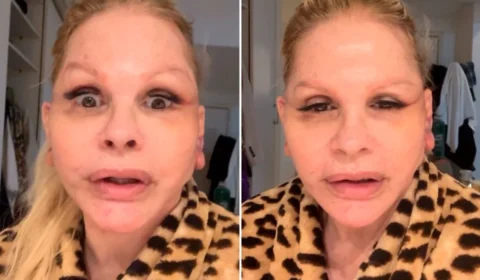 Monique Evans faz cirurgia no rosto e revela surpresa com resultado: “Não me reconheceram”