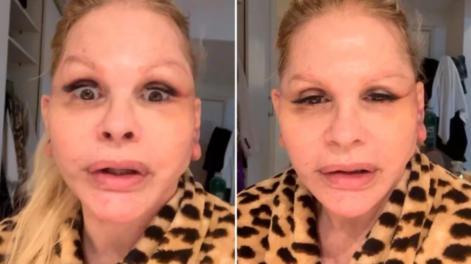 Monique Evans faz cirurgia no rosto e revela surpresa com resultado: “Não me reconheceram”
