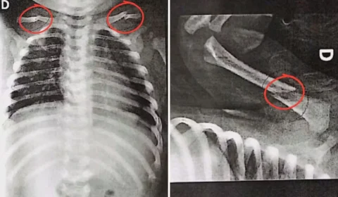 Bebê de 50 dias chega a hospital com várias fraturas e pais são presos por suspeita de maus-tratos