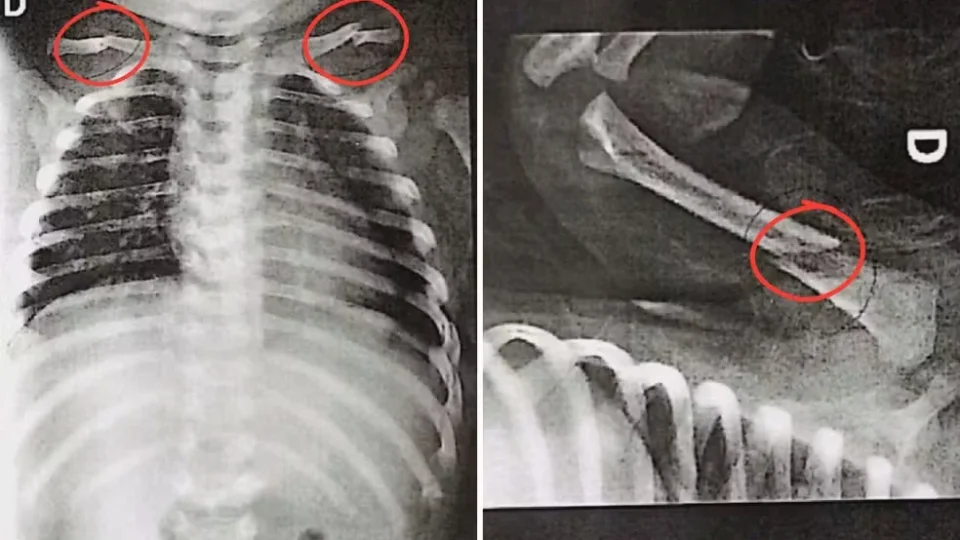 Bebê de 50 dias chega a hospital com várias fraturas e pais são presos por suspeita de maus-tratos