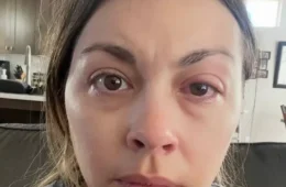 Mulher desenvolve doença ocular após anos dormindo de maquiagem e passa a sofrer com perda temporária da visão