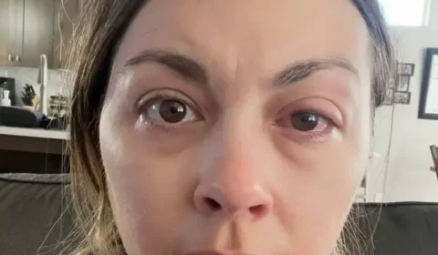 Mulher desenvolve doença ocular após anos dormindo de maquiagem e passa a sofrer com perda temporária da visão