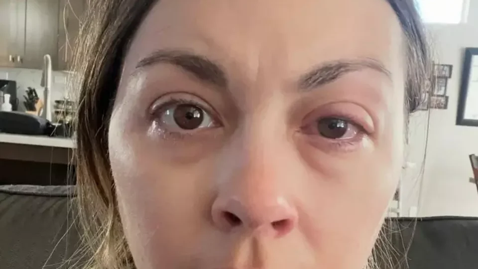 Mulher desenvolve doença ocular após anos dormindo de maquiagem e passa a sofrer com perda temporária da visão