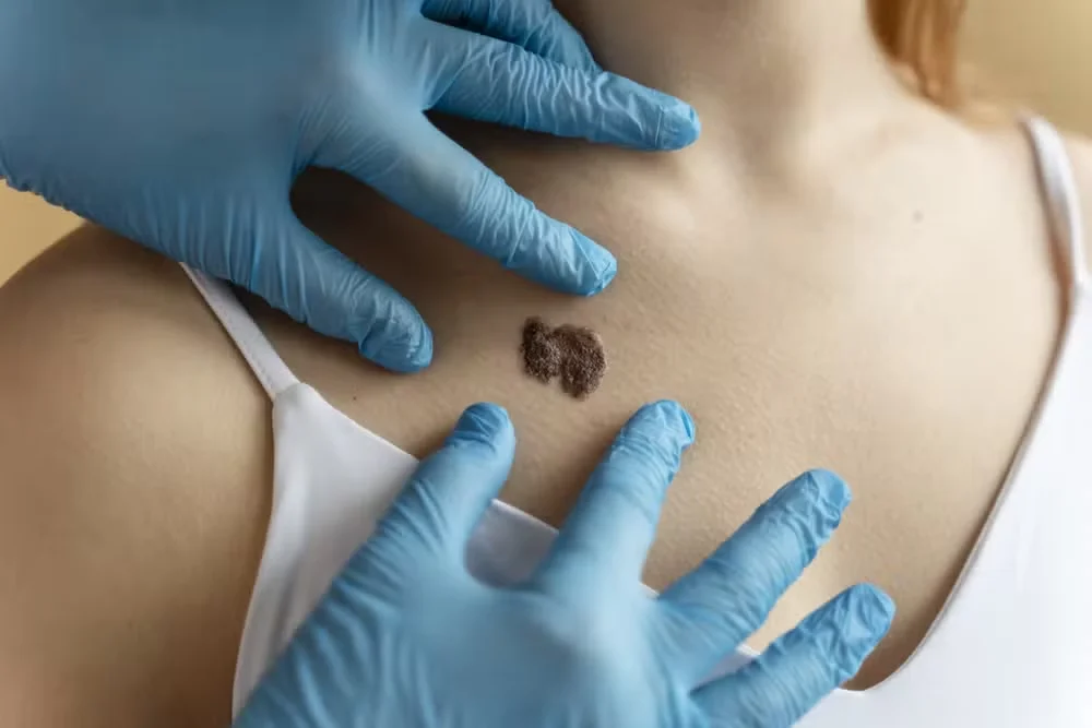 Quando descoberto no início, o câncer de pele tem maior chance de responder bem ao tratamento, inclusive o melanoma, considerado o tipo mais agressivo da doença. — Foto: Freepik