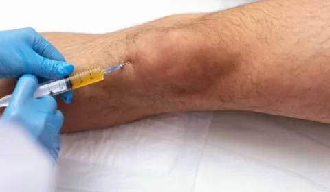 Infiltração no joelho funciona para todo mundo? Entenda benefícios, limites e riscos