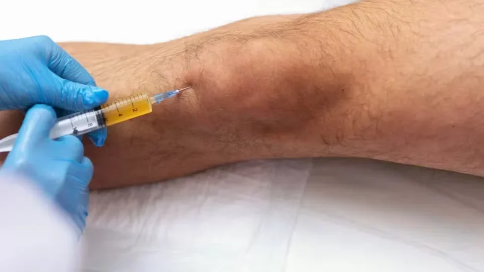 Infiltração no joelho funciona para todo mundo? Entenda benefícios, limites e riscos
