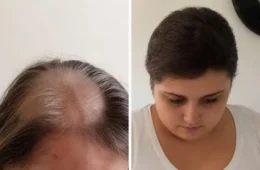 Mulher passa 11 anos fazendo quimioterapia por câncer que nunca teve