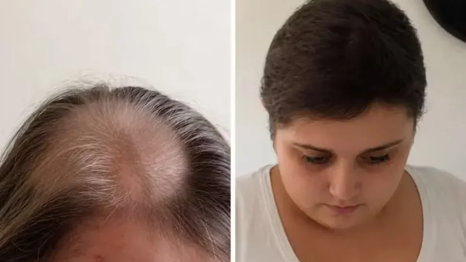 Mulher passa 11 anos fazendo quimioterapia por câncer que nunca teve