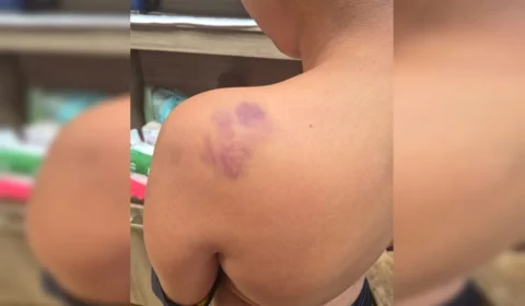 Aluno de 12 anos é agredido após sofrer ofensas racistas em escola do DF