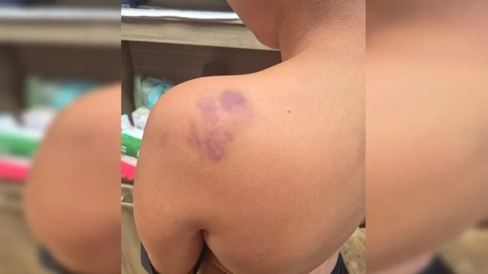 Aluno de 12 anos é agredido após sofrer ofensas racistas em escola do DF