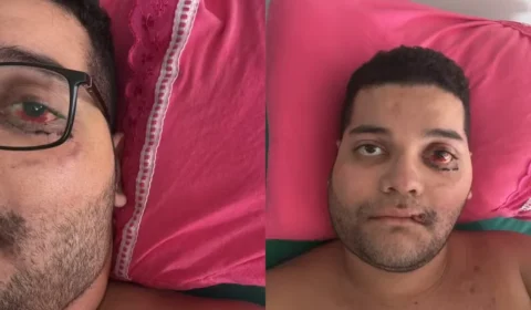 Motociclista fratura rosto e bacia em grave acidente na BR-364 e segue internado