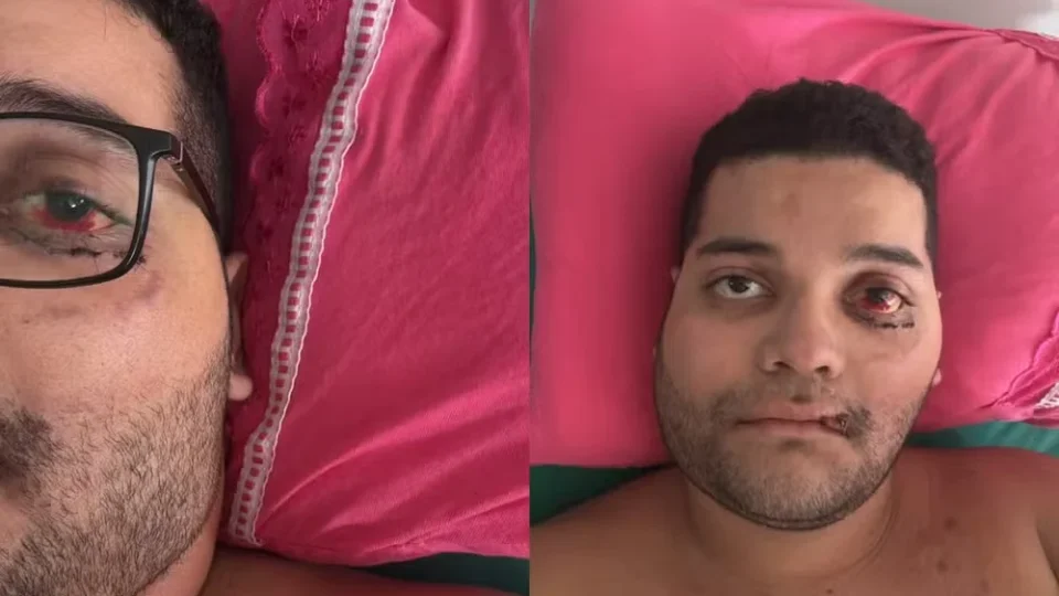 Motociclista fratura rosto e bacia em grave acidente na BR-364 e segue internado