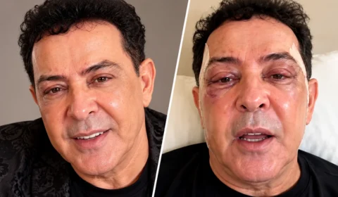 VÍDEO: Beto Barbosa surge com rosto irreconhecível após plástica e choca internet com novo visual