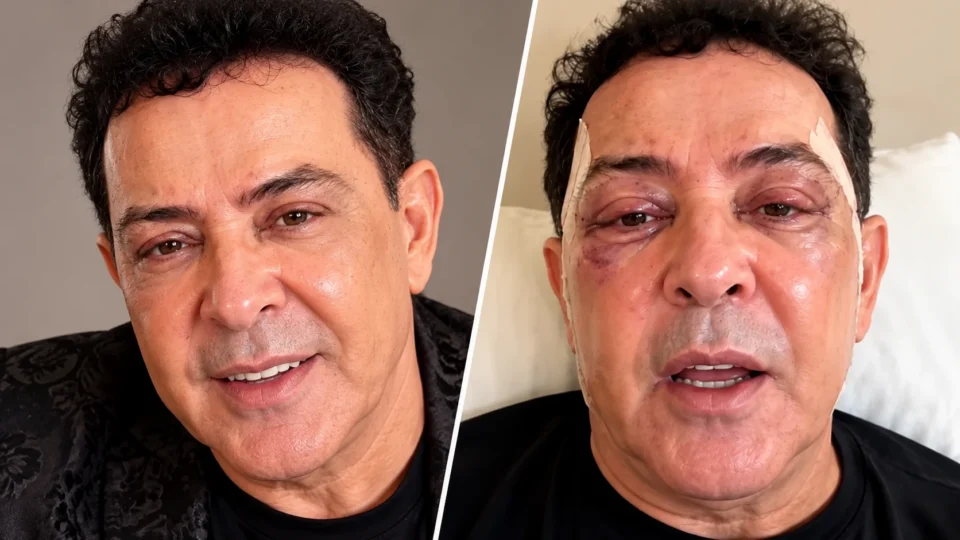 VÍDEO: Beto Barbosa surge com rosto irreconhecível após plástica e choca internet com novo visual