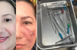 Falsa médica é presa após deixar paciente com rosto deformado no Amapá