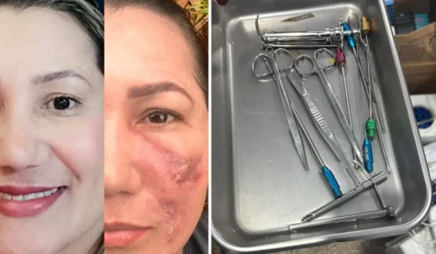 Falsa médica é presa após deixar paciente com rosto deformado no Amapá