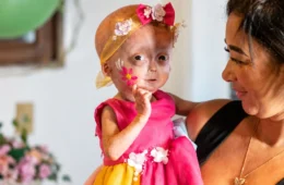 Elis, uma das gêmeas com síndrome rara de envelhecimento precoce, morre aos cinco anos