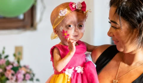 Elis, uma das gêmeas com síndrome rara de envelhecimento precoce, morre aos cinco anos