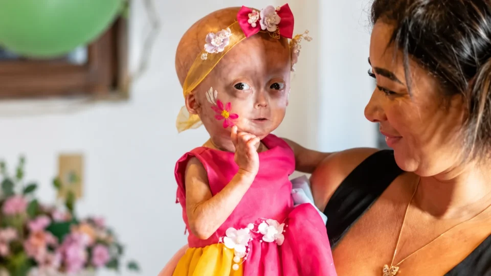 Elis, uma das gêmeas com síndrome rara de envelhecimento precoce, morre aos cinco anos