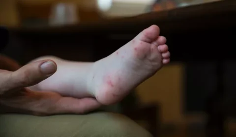 Doença mão-pé-boca é contagiosa e exige atenção aos sintomas e à hidratação
